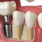 Dental implant model next to teeth with natural roots in Katy, TX