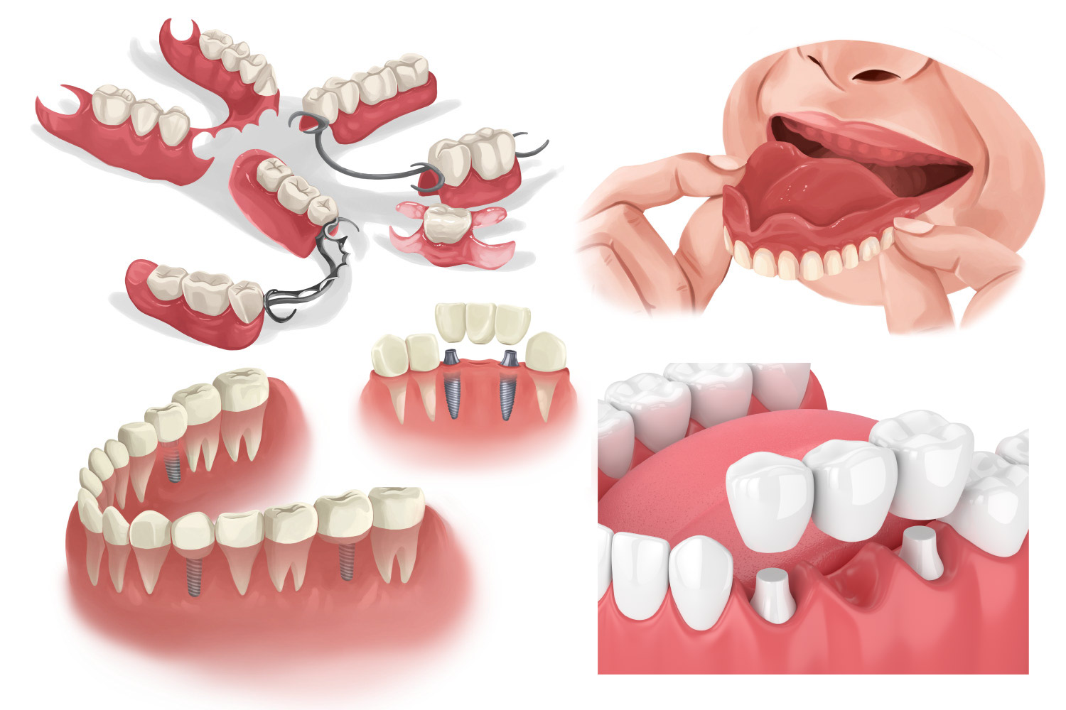 Images showing various configurations of tooth replacements using full dentures, partial dentures, dental bridges, and dental implants