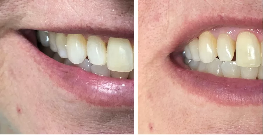 Before and after white tooth filling