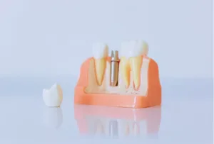 Dental Implants in Katy